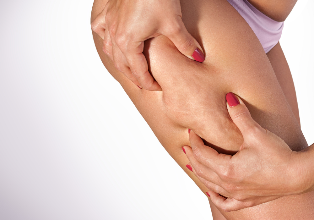 cellulite removal in northern virginia with Venus Bliss