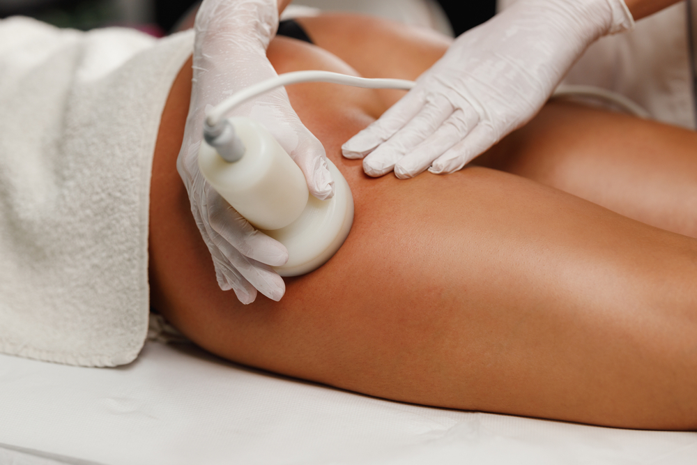 cellulite treatment Northern Virginia