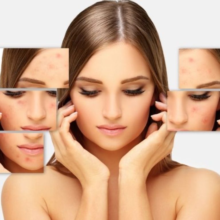 acne scar specialist arlington