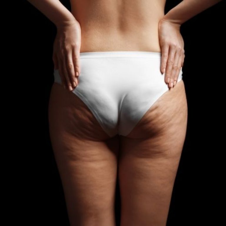 cellulite specialist tysons corner