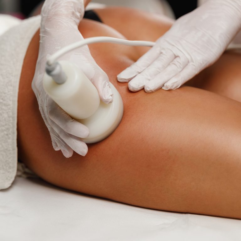 cellulite treatment Northern Virginia