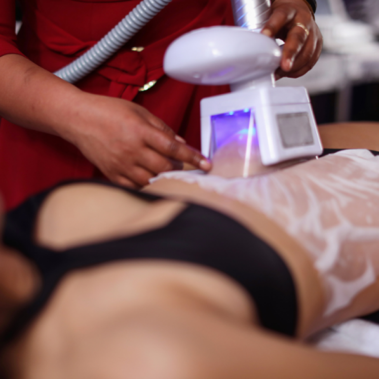 cryolipolysis arlington