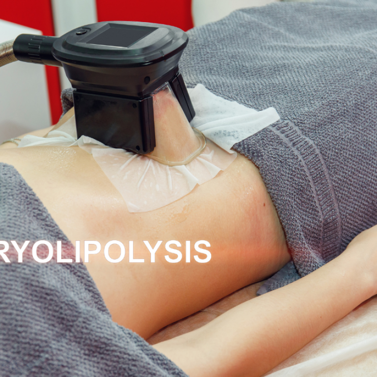 cryoskin coolsculpting arlington