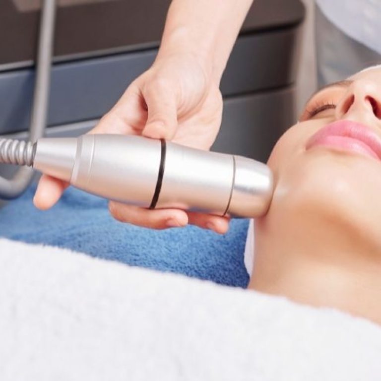 IPL dark spot removal arlington