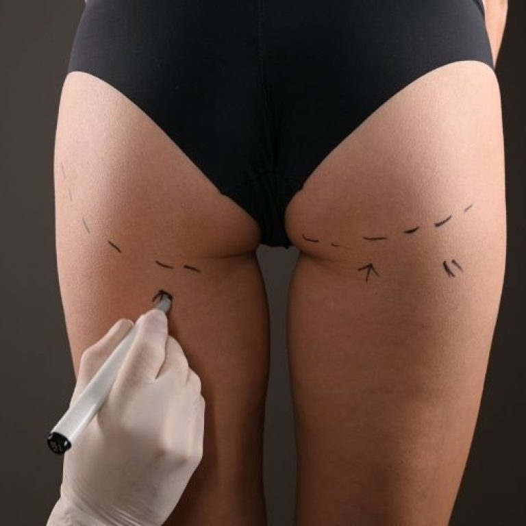 emsculpt alternative to BBL in arlington