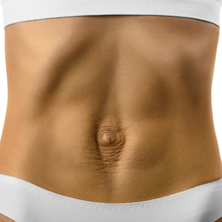 emsculpt for diastasis recti