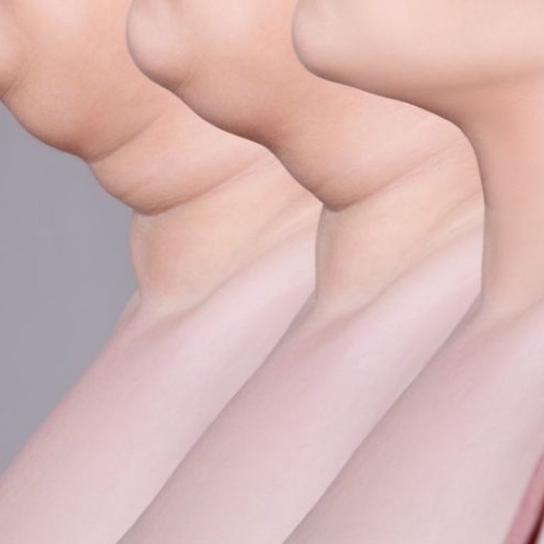 kybella results arlington