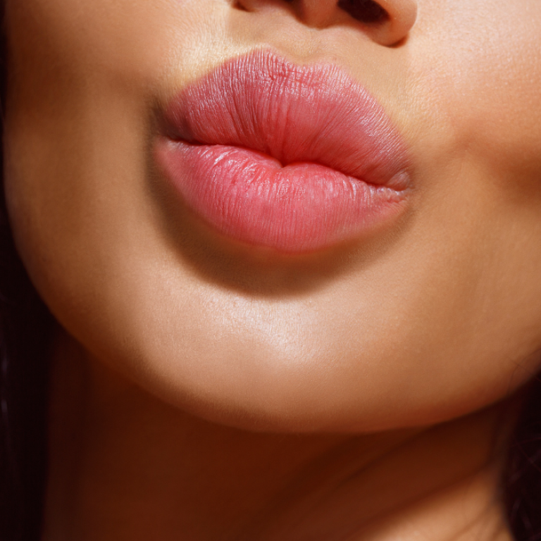 woman posing after lip fillers in Arlington