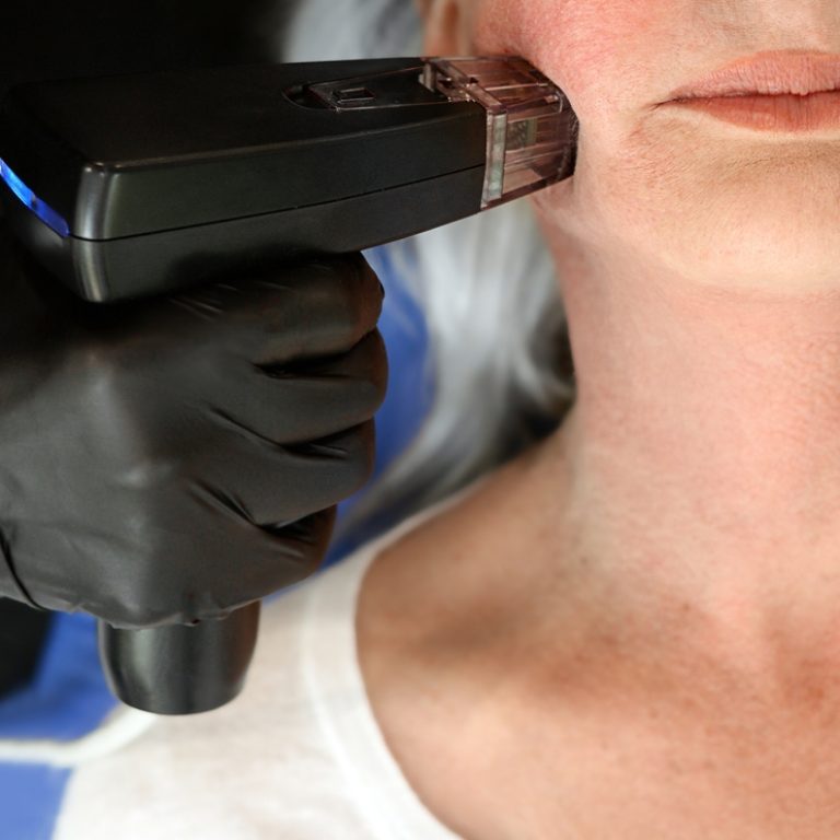 tighten skin near Warrenton with Morpheus8
