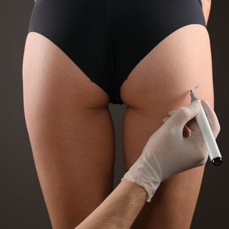 non-surgical BBL tysons corner