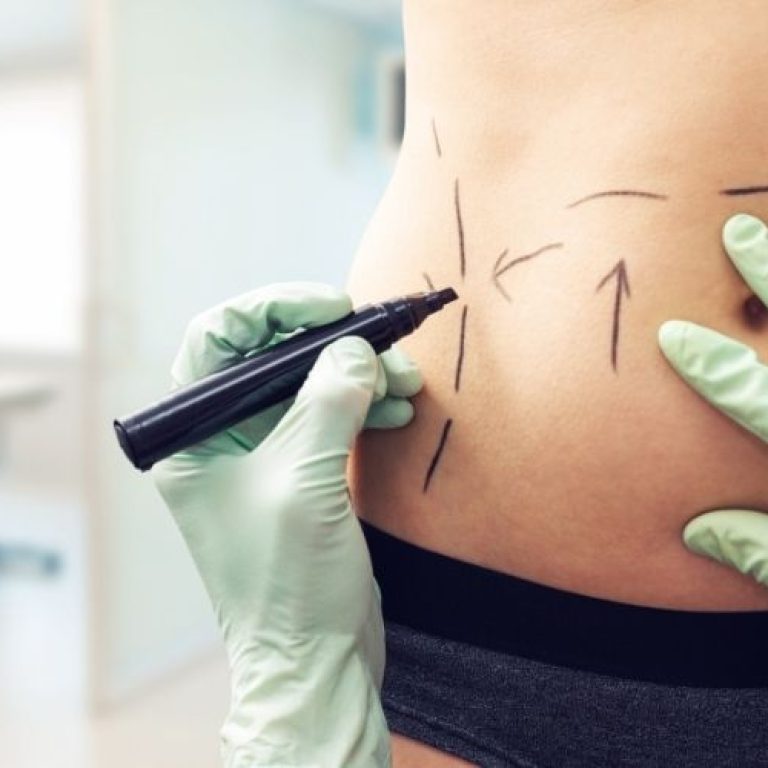 risks tummy tuck arlington