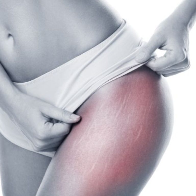 stretch mark specialist falls church