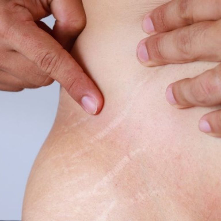 stretch marks treatment northern virginia